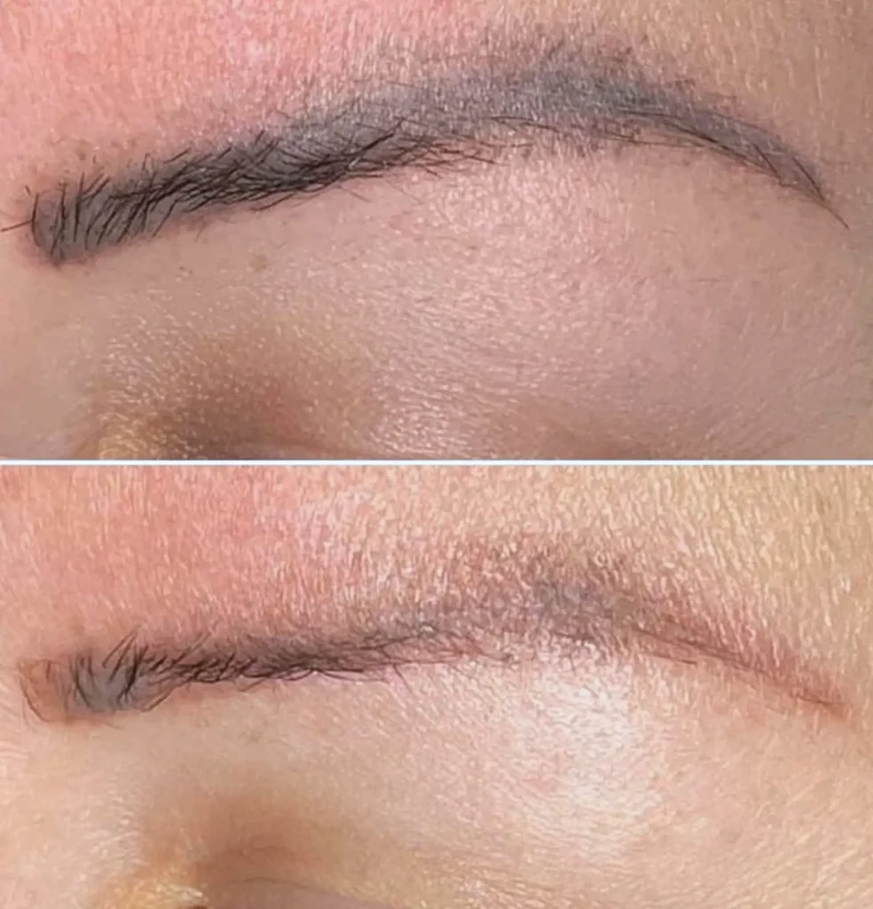 eyebrow tattoo removal