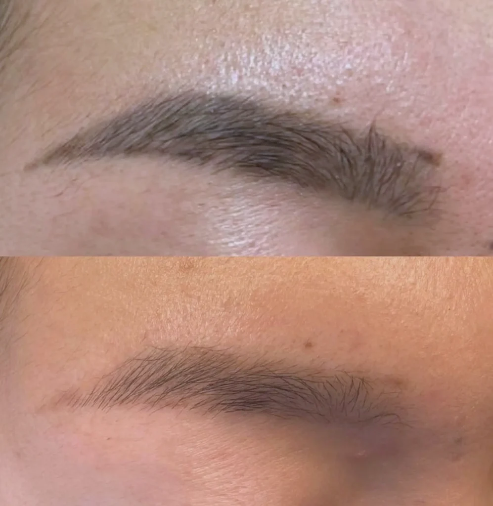 eyebrow tattoo removal cost