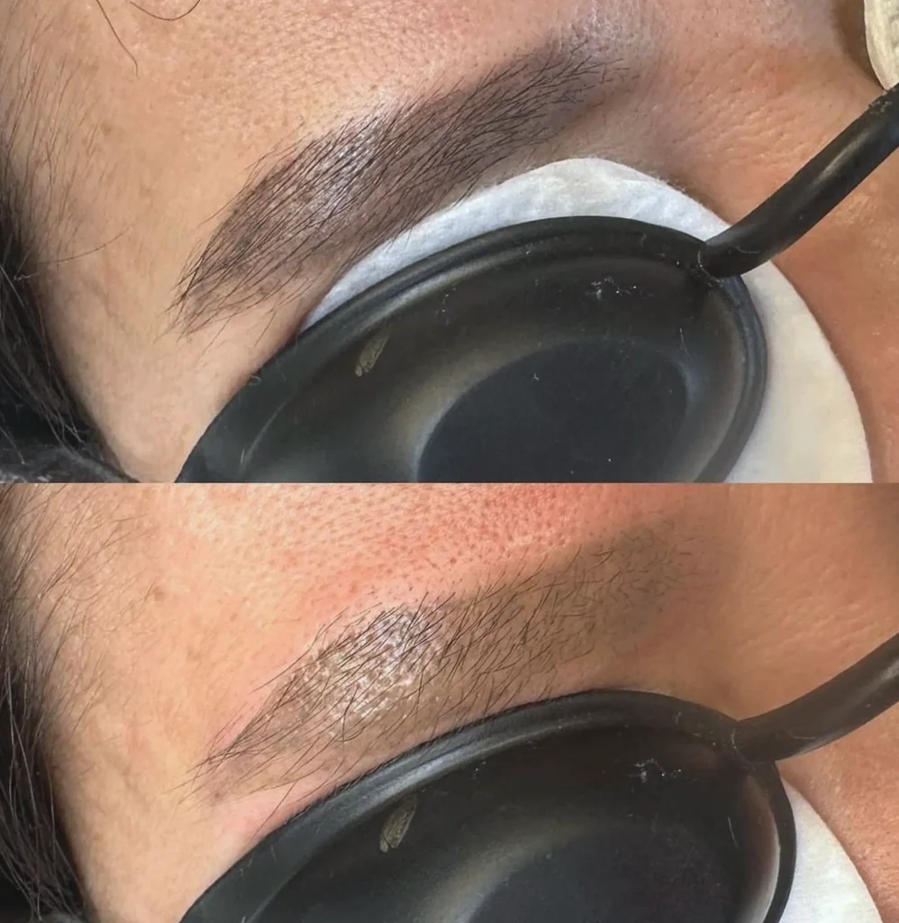 eyebrow tattoo removal melbourne