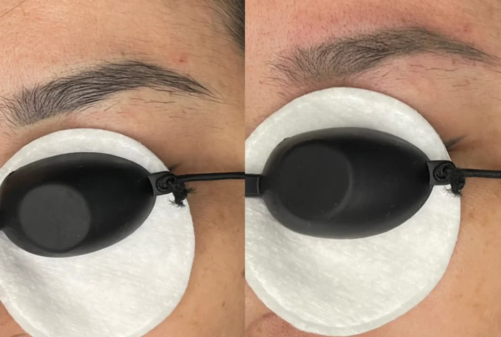 eyebrow tattoo removal near me