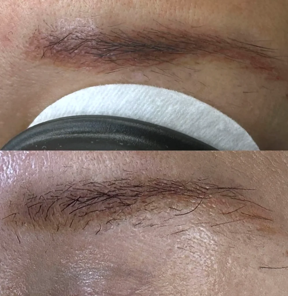 laser eyebrow removal