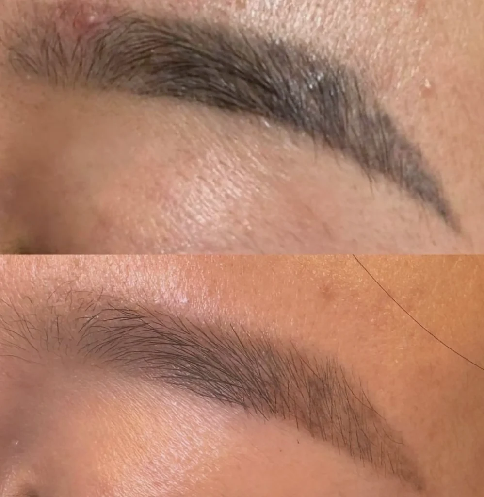 laser eyebrow removal melbourne