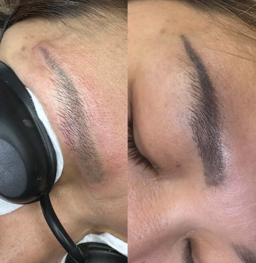 laser eyebrow tattoo removal price