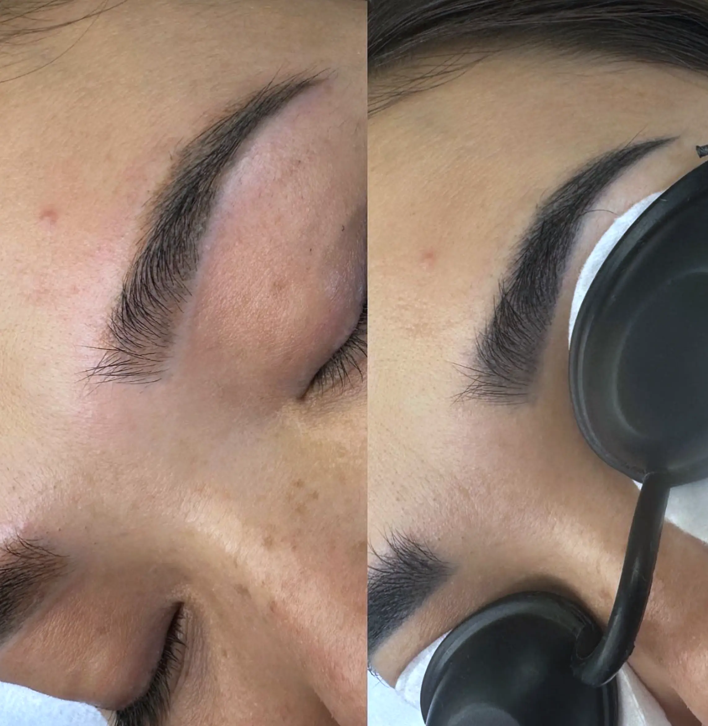 Eyebrow Tattoo Removal