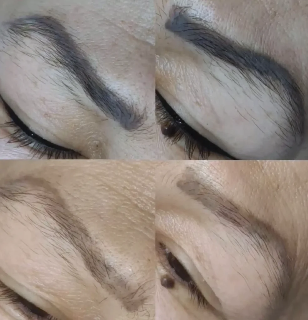 tattoo eyebrow removal